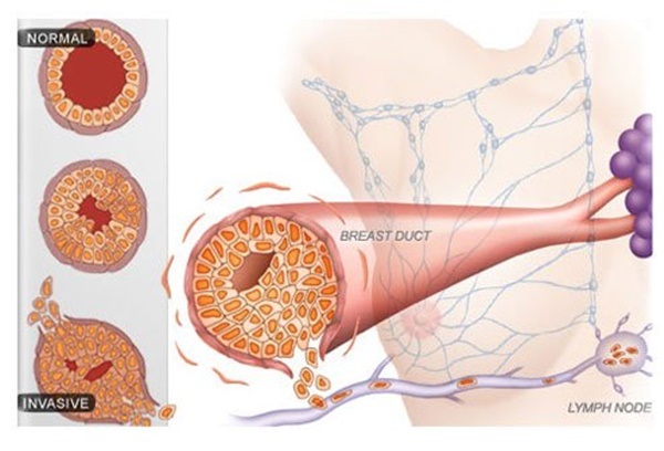 سرطان الثدي أعراضه وأسباب الإصابة به