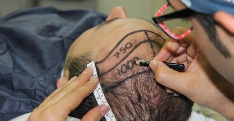 أحدث ثلاث تقنيات لزراعة الشعر بالاقتطاف