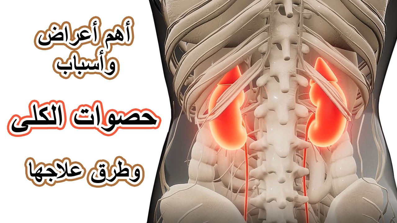 حصوات الكلى ..  الوقاية  والعلاج