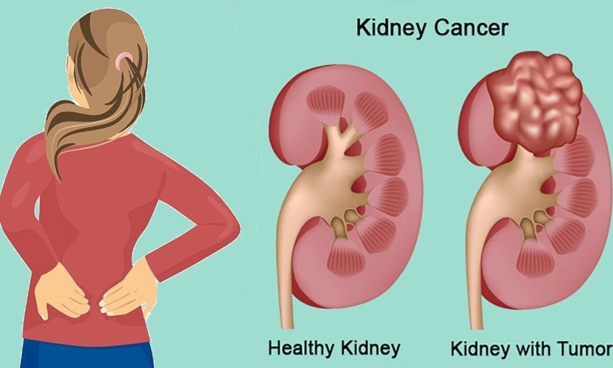 الشعور بالألم في أحد جوانب الجسم لا يعني الإصابة بأمراض الكلي