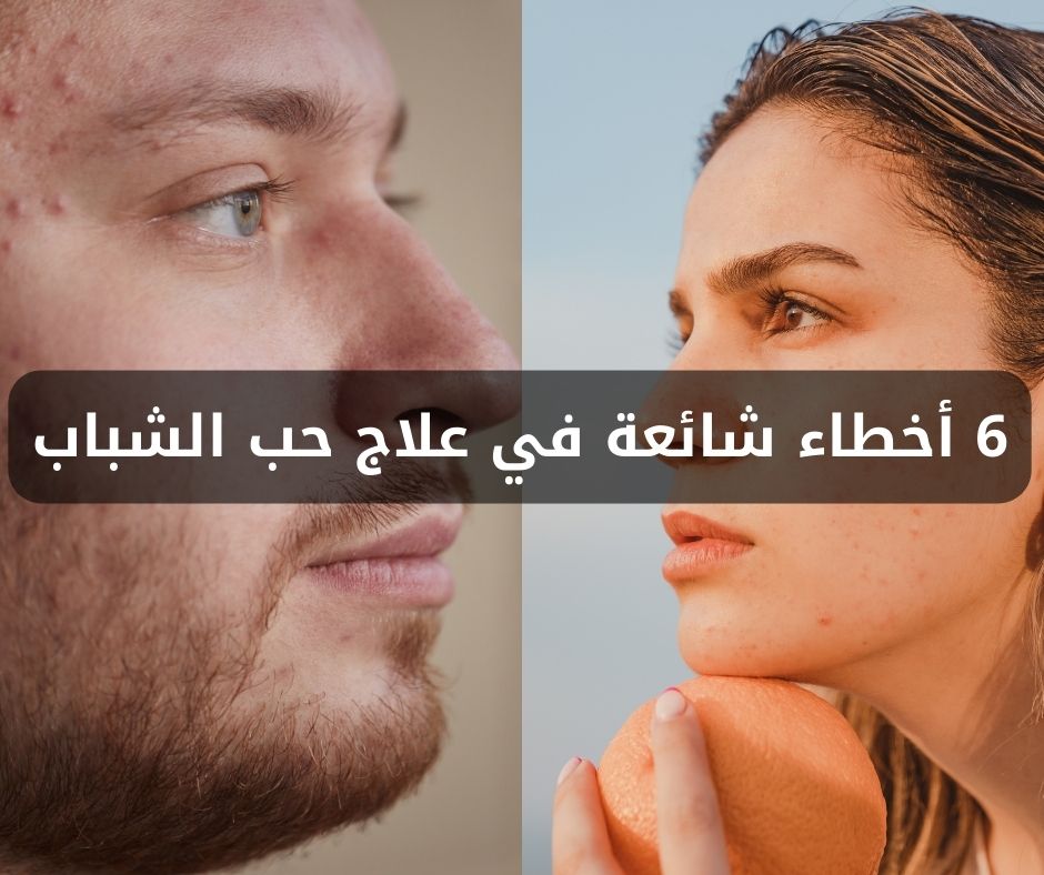 6 أخطاء شائعة في علاج حب الشباب